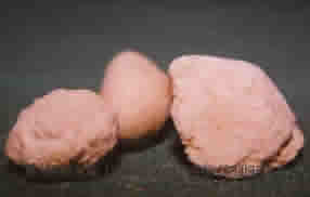 Calcoli renali