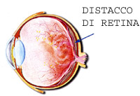 distacco di retina