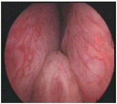 Ipertrofia prostatica benigna