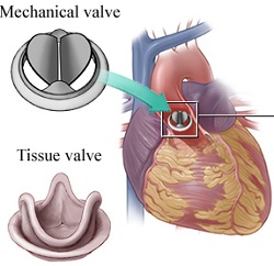 Durata di una valvola meccanica aortica