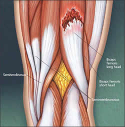 Strappo muscolare