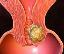 Tumore dell'utero