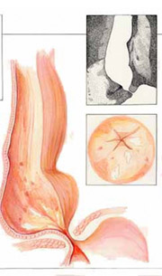 acalasia