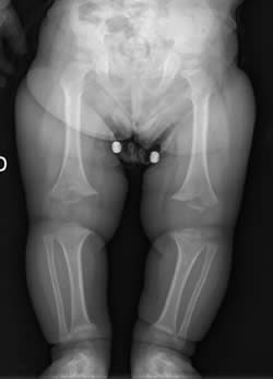 Acondroplasia