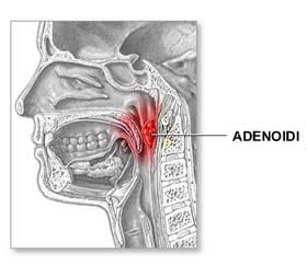 Adenoidi ipertrofiche e adenoidite