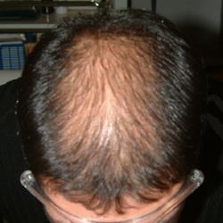 Alopecia