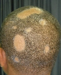 Alopecia areata