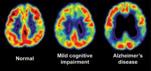Alzheimer