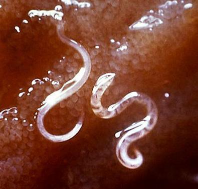 Anchilostomiasi