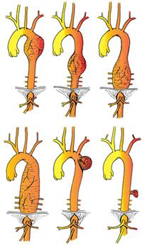 Aneurisma dell'aorta