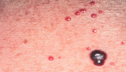 Angioma
