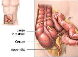 Appendicite