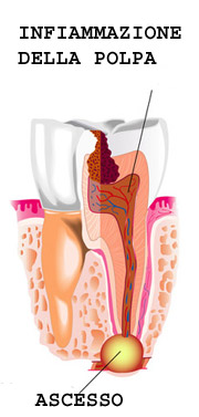 Ascesso dentale