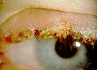 Occhio blefarite