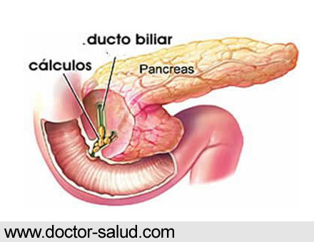 Calcolosi pancreatica