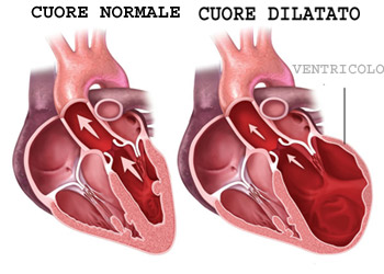 Cardiomiopatia dilatativa