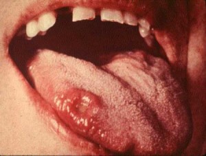 Chlamydia