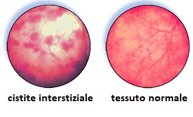 Cistite interstiziale