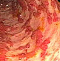 Colite ulcerosa