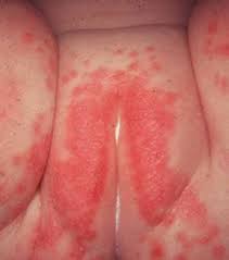 Dermatite da pannolino