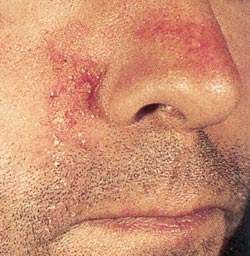 Dermatite seborroica