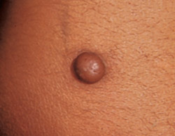 Dermatofibroma