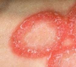 Dermatofitosi