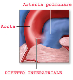 Difetto interatriale