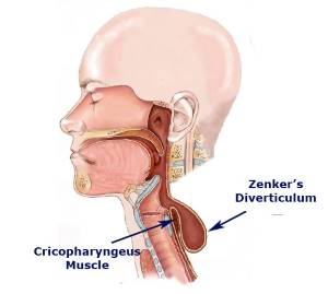 Diverticolo di Zenker