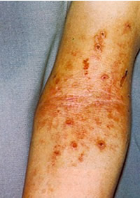 Eczema o dermatite