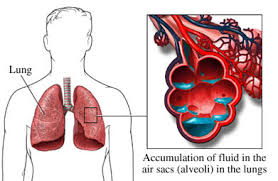 Edema polmonare acuto