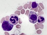 emoglobinuria