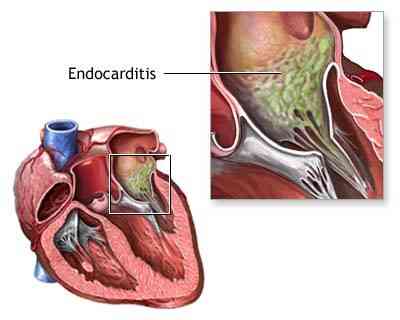 endocardite