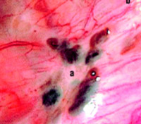 Endometriosi