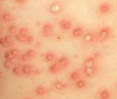 Epidermolisi bollosa