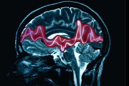 epilessia