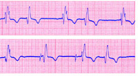 Fibrillazione atriale