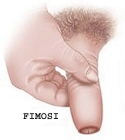 Fimosi