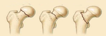 Frattura del collo del femore