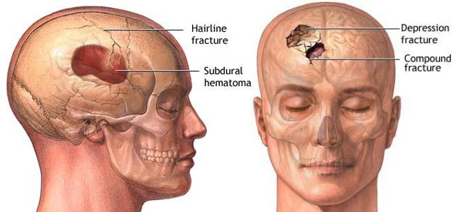 Fratture del cranio