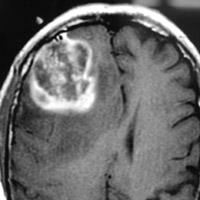 Glioblastoma