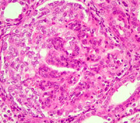 Glomerulonefrite