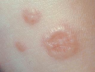Granuloma anulare