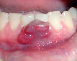Granuloma piogenico