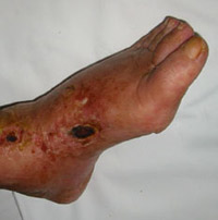 Granulomatosi di Wegener