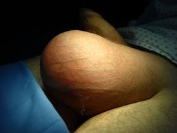 Idrocele