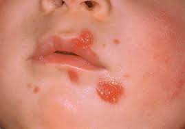 Impetigine