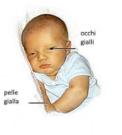 Ittero neonatale