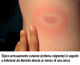 Malattia di Lyme