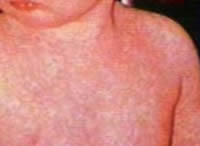 Morbillo